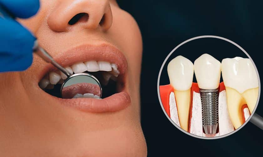 Dental Implants in Grapevine TX
